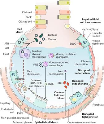 Gene Therapy for Acute Respiratory Distress Syndrome